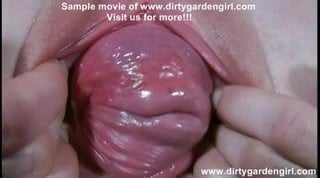 best of Prolapse pussy and cervix amazing